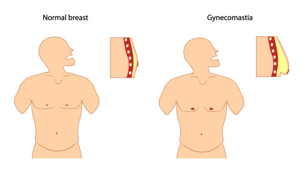 Gynecomastia